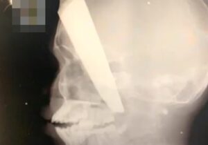 【超閲覧注意】ナイフが頭をこれだけ貫通しても運がいいと生き残れるという事実