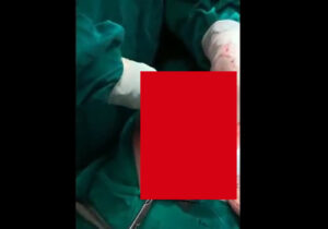 【超閲覧注意】自分の髪の毛を食べ続ける奇病 ”ラプンツェル症候群” を患った女の子の末路がこちら