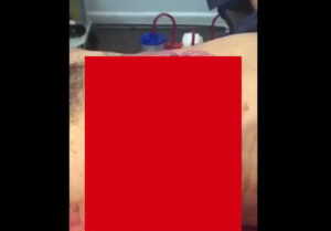 【超閲覧注意】腹から飛び出した大量の内蔵が体内に戻ろうとしているんだが・・(動画)