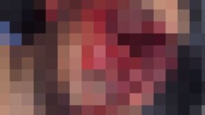 顔面がグチャグチャに…バイクの事故で重傷を負った男性【超閲覧注意】